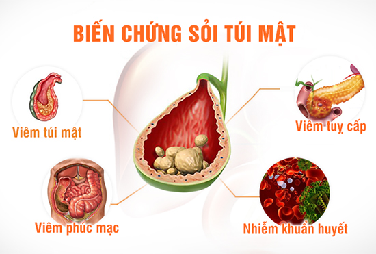 Biến chứng nguy hiểm của bệnh sỏi mật