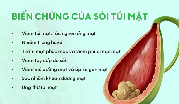 Minh họa các biến chứng sỏi mật