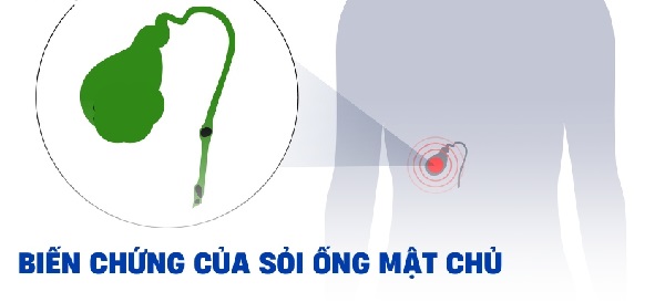 So sánh biến chứng do sỏi mật không được điều trị