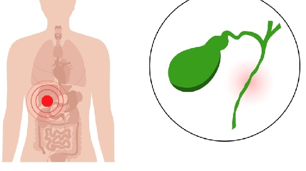 Phòng ngừa sỏi mật bằng thảo dược THAPHACO