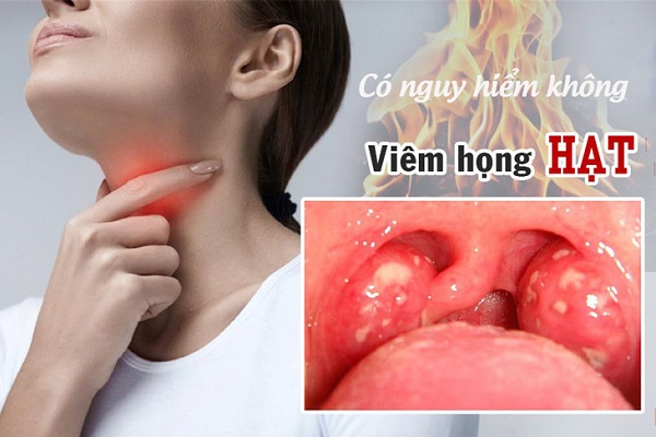 Chủ động phòng ngừa biến chứng viêm họng hạt