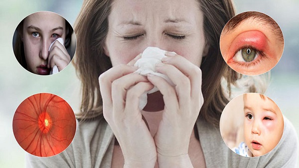 Hậu quả khó lường khi dùng thuốc không đúng cách trị viêm xoang