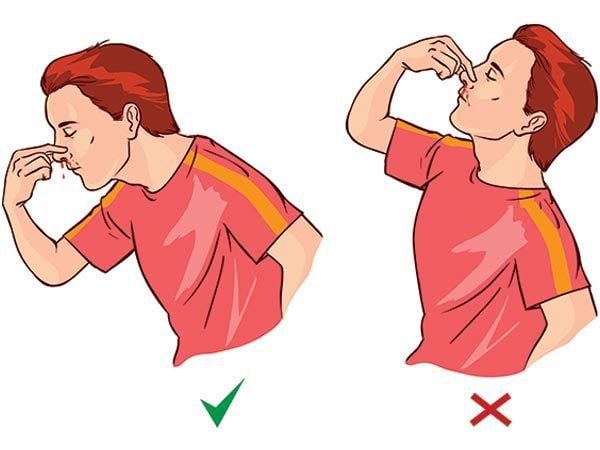 Nguyên nhân gây chảy máu mũi phổ biến