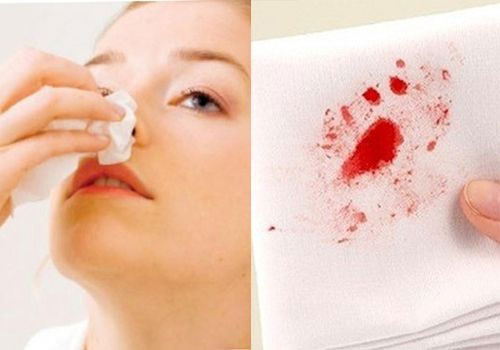 Lời khuyên xử lý và phòng ngừa chảy máu cam