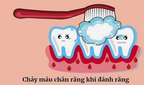 Chảy máu khi đánh răng có nguy hiểm không