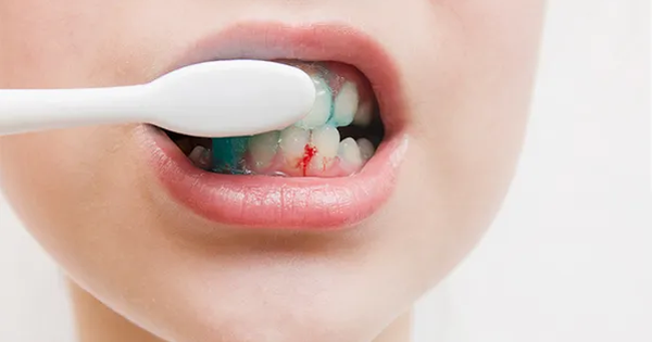 Nguyên nhân gây chảy máu nướu răng khi đánh răng