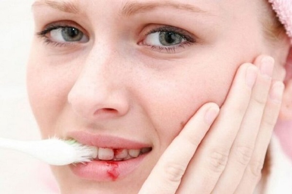 Mức độ nguy hiểm của chảy máu khi đánh răng