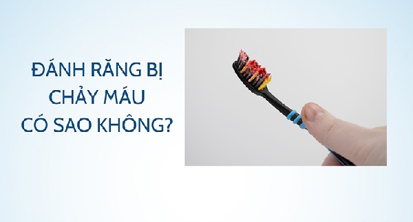 Giải pháp phòng ngừa chảy máu nướu răng