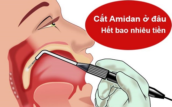 Các yếu tố ảnh hưởng đến chi phí cắt amidan