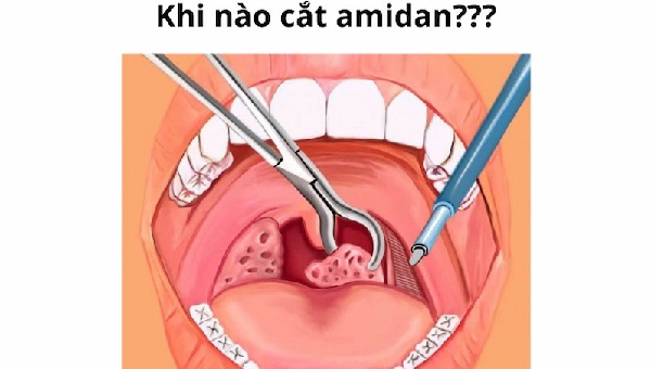 So sánh chi phí điều trị amidan giữa các phương pháp