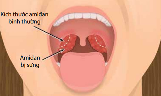 Bác sĩ tư vấn lựa chọn phương pháp cắt amidan phù hợp