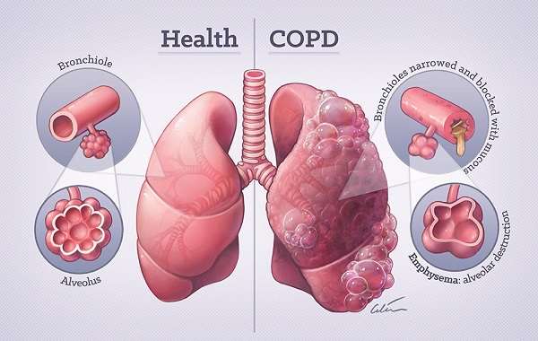 COPD là gì và mối liên hệ với viêm phổi