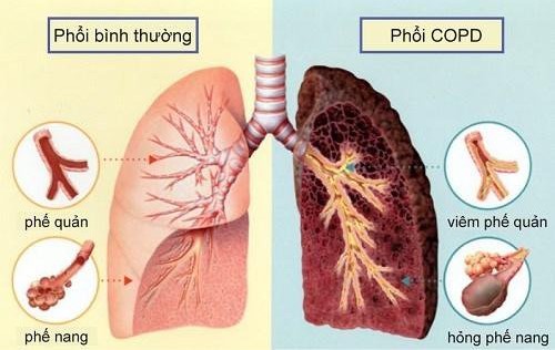 Triệu chứng của COPD dễ nhầm lẫn với viêm phổi