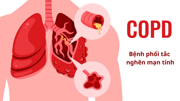 COPD làm tăng nguy cơ mắc viêm phổi