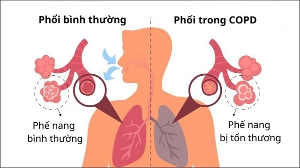 Làm thế nào để phòng ngừa COPD và viêm phổi hiệu quả?