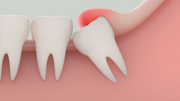 Triệu chứng mọc răng khôn và các nguyên nhân khác