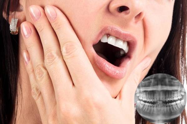 Lời khuyên xử lý đau hàm nghi mọc răng khôn
