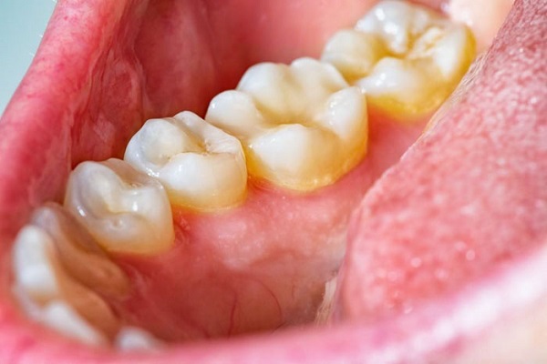 Chảy máu nướu, sưng viêm - dấu hiệu răng miệng cần lưu ý
