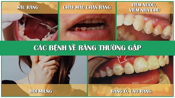 Nguyên nhân gây bệnh răng miệng phổ biến
