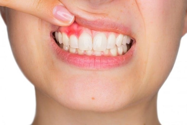 Chăm sóc răng miệng bằng thảo dược thiên nhiên