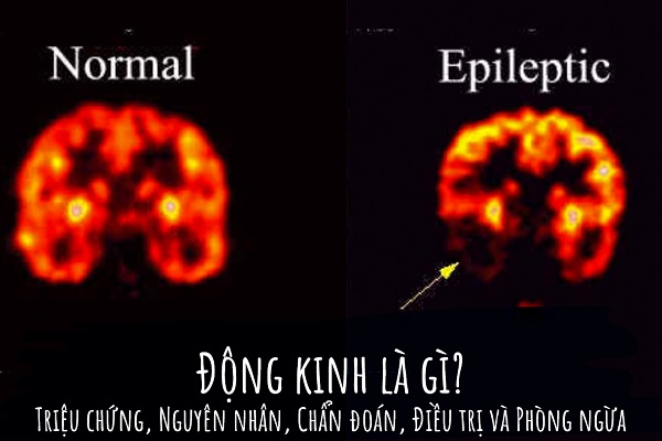 Nguy cơ tiềm ẩn khi hiểu sai về động kinh & chức năng não