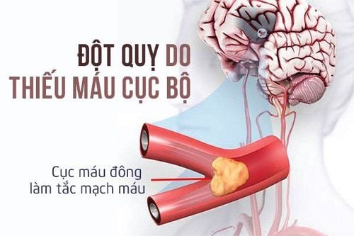 Cơ chế đột quỵ làm mất trí nhớ