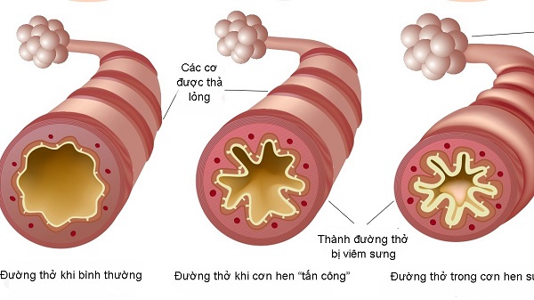 Mối liên quan giữa hen phế quản và polyp mũi trong tai mũi họng