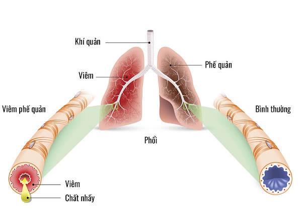 Khoa học chứng minh mối liên quan giữa hen phế quản và polyp mũi