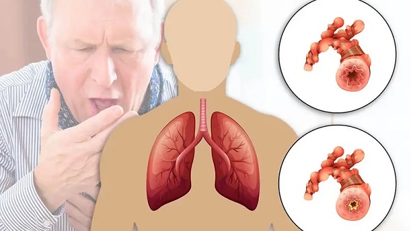 Nguy cơ phổi và sự ảnh hưởng giữa các yếu tố