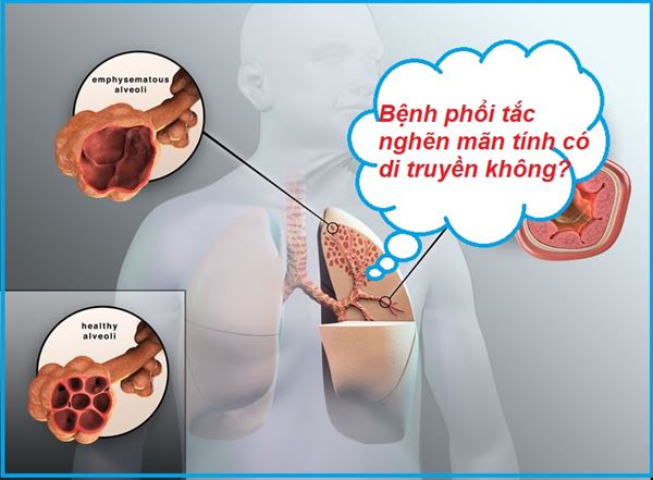 Chọn lựa thảo dược chất lượng phòng tránh bệnh phổi