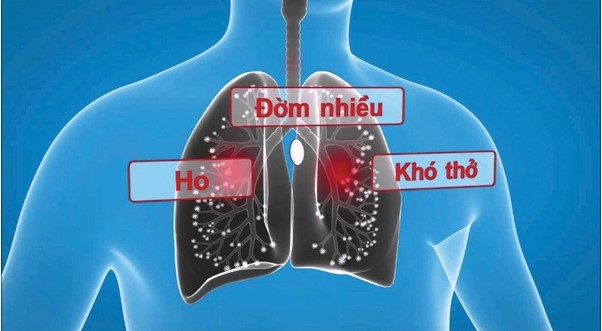 Triệu chứng viêm phổi cần nhận diện sớm