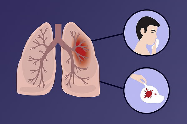 Các nguyên nhân gây ho ra máu liên quan đến phổi