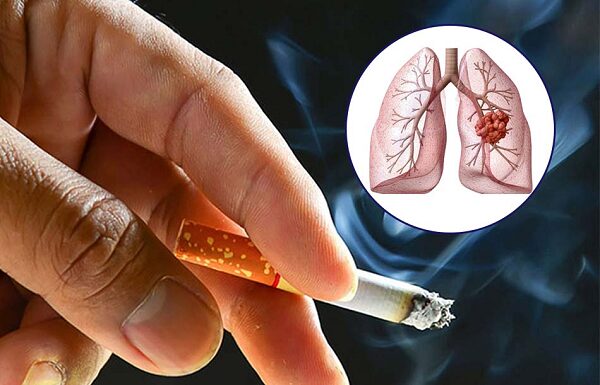 Phòng tránh ung thư phổi nhờ từ bỏ thuốc lá