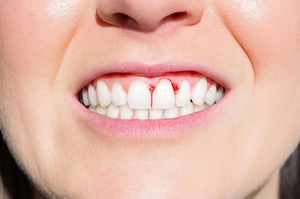 Lợi sưng đỏ đau nhẹ là tình trạng phổ biến nhưng dễ bị xem nhẹ