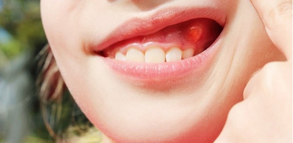 Nguyên nhân lợi sưng đỏ đau nhẹ và các yếu tố nguy cơ