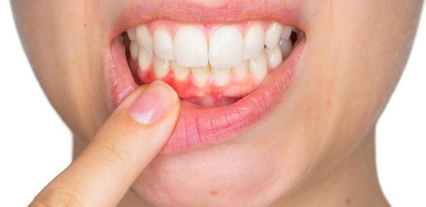 Triệu chứng điển hình của viêm lợi cấp: đau, sưng, đỏ, chảy máu