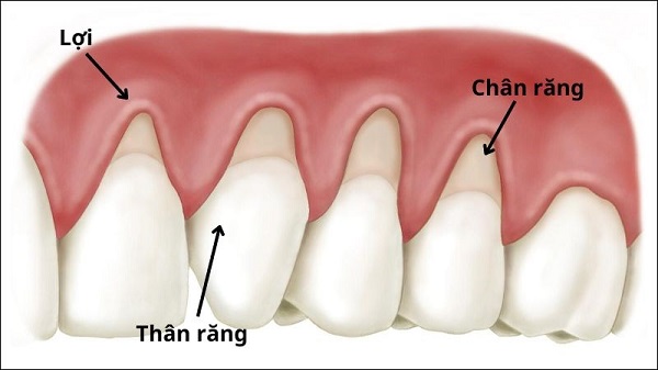 Rủi ro khi tự ý điều trị lợi sưng đau không đúng cách