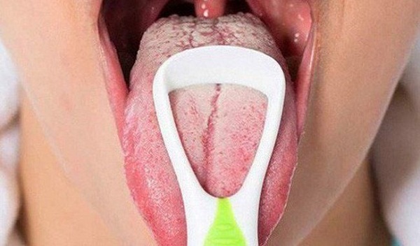 Nguyên nhân lưỡi bị nứt đau rát khi ăn cay