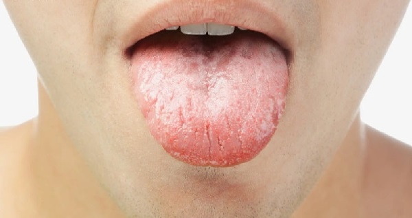 Chăm sóc lưỡi bị nứt đau rát đúng cách