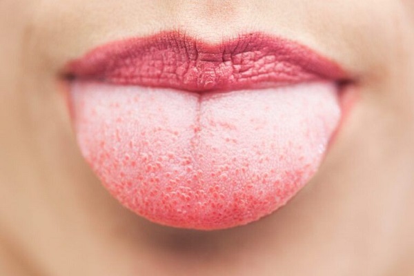 Lưỡi nổi nhiều mảng trắng và đốm đỏ - Dấu hiệu bất thường trong răng miệng