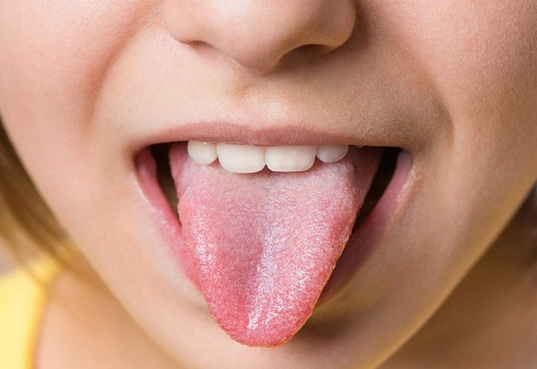 Triệu chứng của lưỡi nổi mảng trắng, đốm đỏ