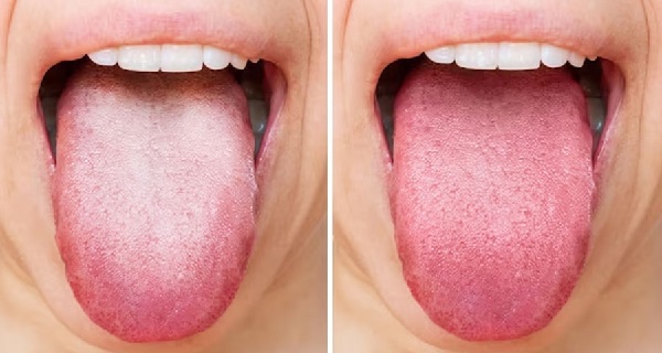 Phân biệt nấm miệng và các nguyên nhân khác