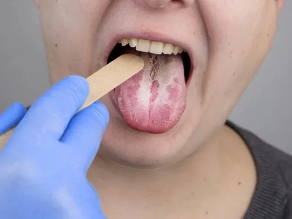 Cảnh báo rủi ro tự ý điều trị lưỡi nổi mảng trắng, đốm đỏ
