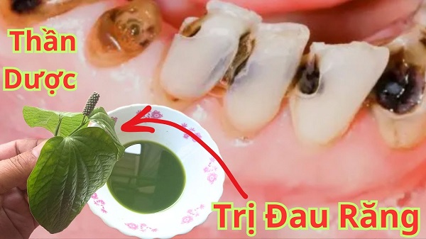 Những lưu ý khi dùng mẹo dân gian trị sâu răng tại nhà