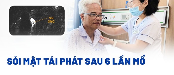 Hình ảnh minh họa mổ lấy sỏi mật và nguy cơ tái phát