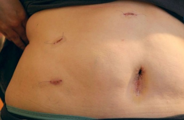 Cảnh báo rủi ro khi tự ý điều trị sỏi mật