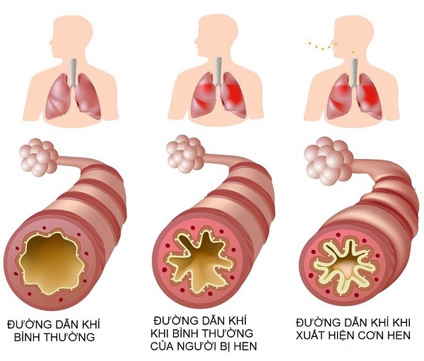 Nhiều yếu tố môi trường và lối sống tác động đến phổi