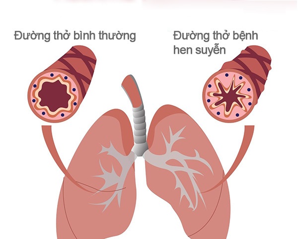 Hen suyễn, viêm phổi và những nguy cơ sức khỏe cộng hưởng