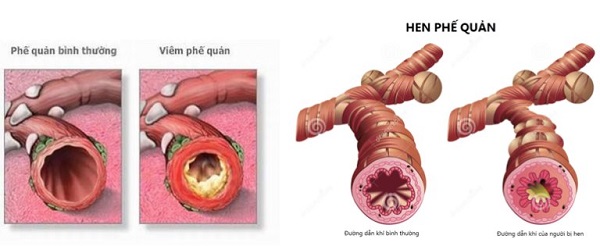 Thảo dược hỗ trợ điều trị, tăng cường sức khỏe hô hấp
