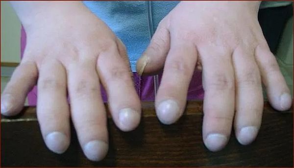 Đầu ngón tay dày lên, bóng mượt là dấu hiệu không thể chủ quan